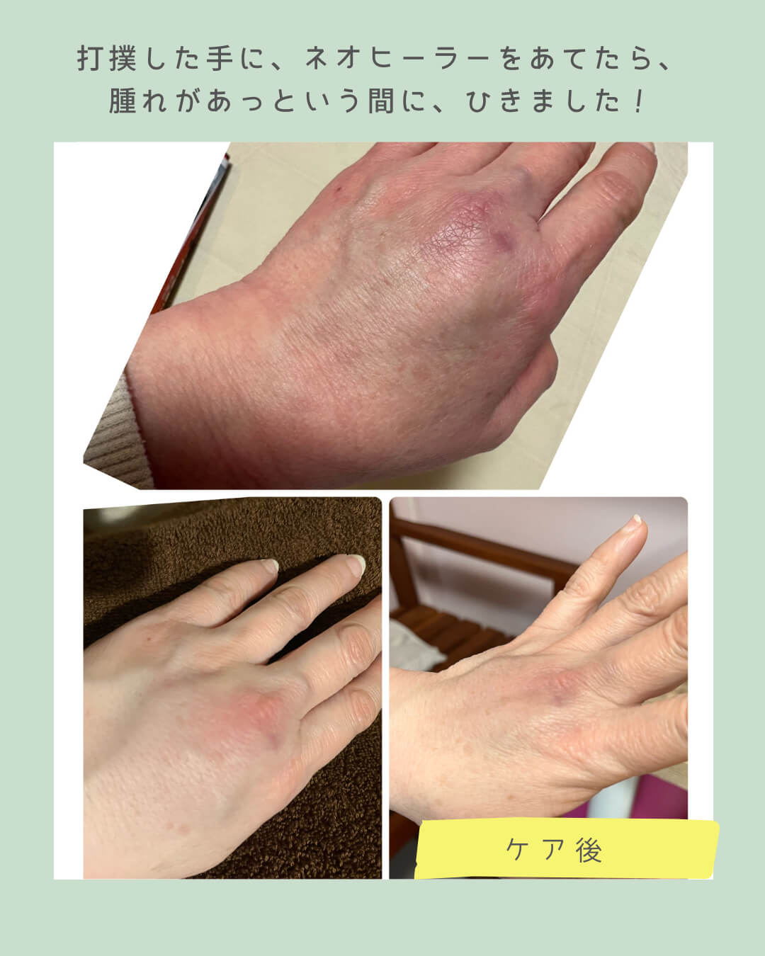 ネオヒーラー体験 手の打撲に施術